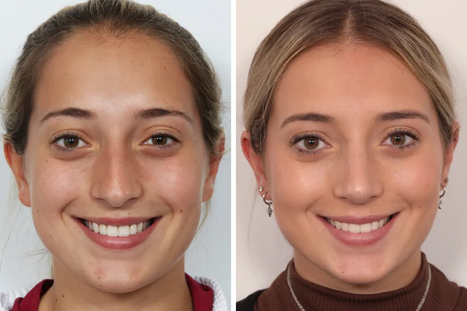 Rhinoplasty