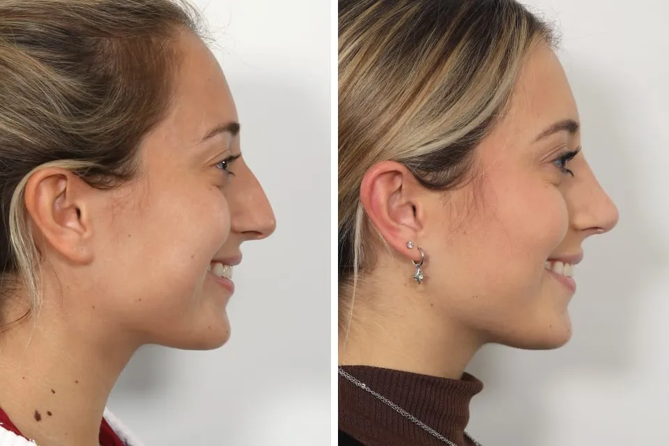 Rhinoplasty