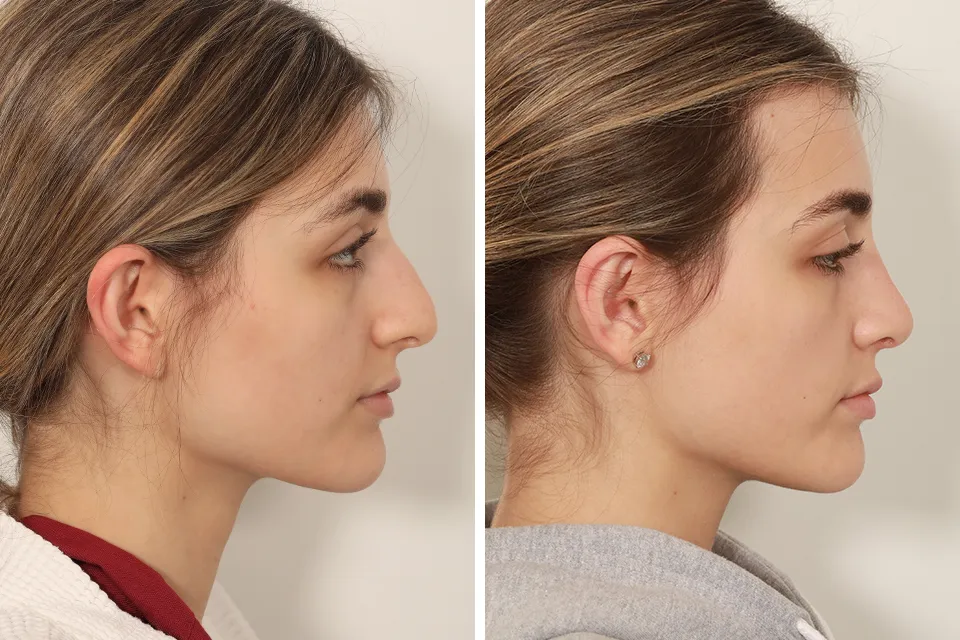 Rhinoplasty