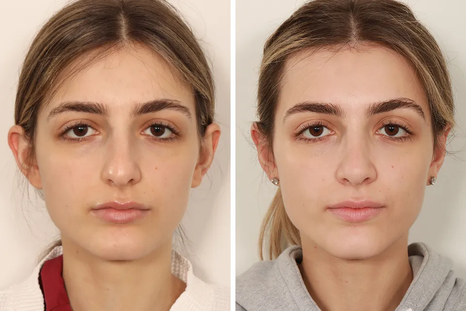 Rhinoplasty