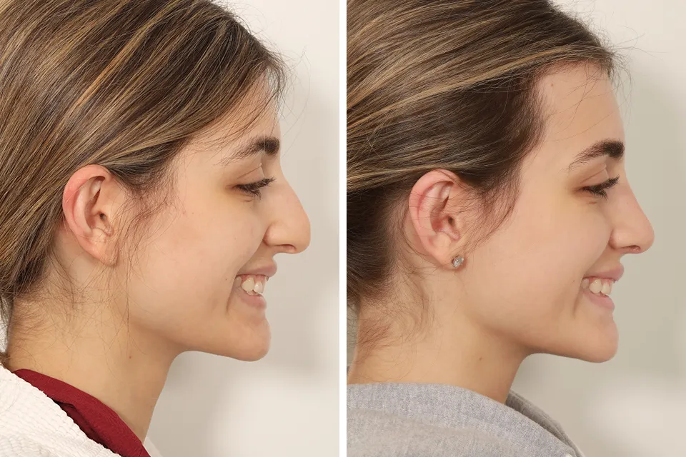 Rhinoplasty