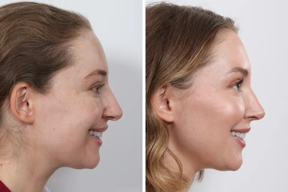 Rhinoplasty