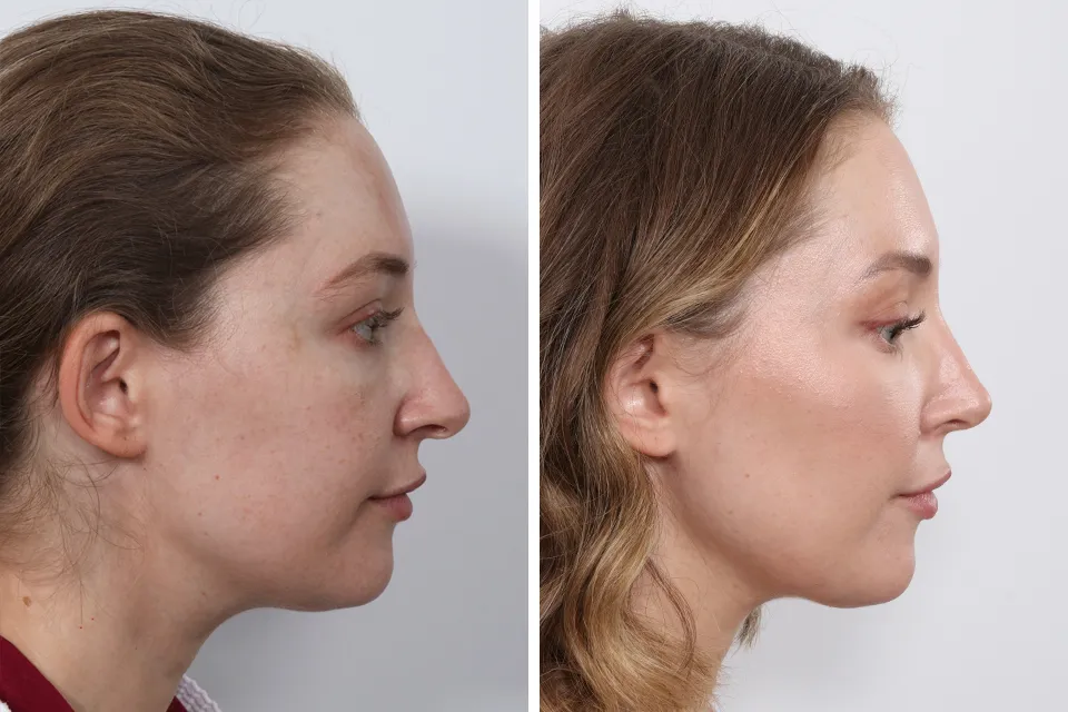 Rhinoplasty