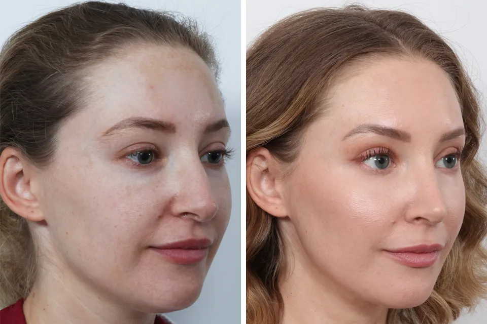 Rhinoplasty