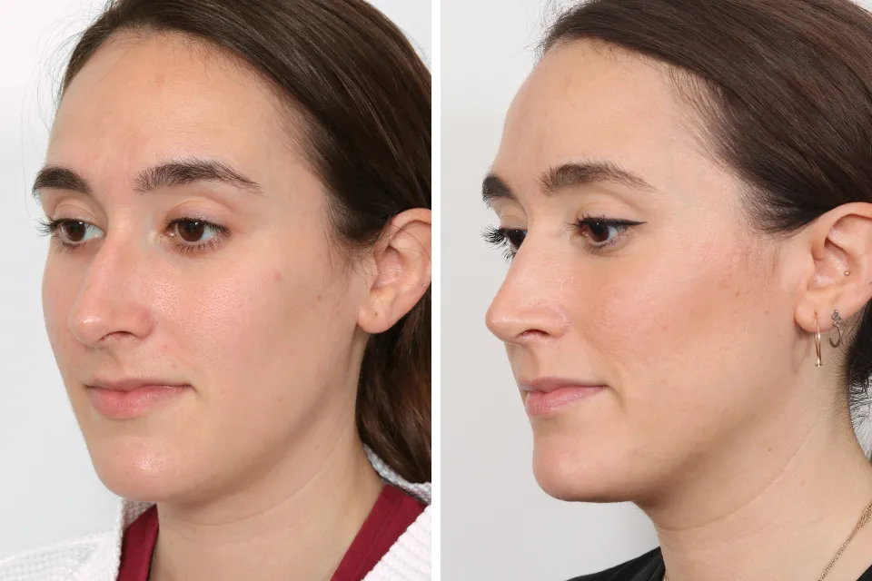 Rhinoplasty