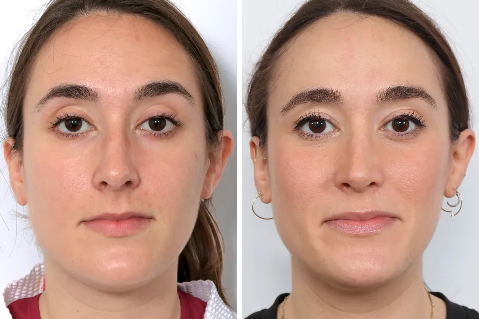 Rhinoplasty