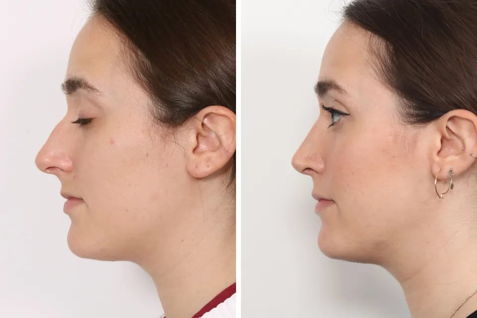 Rhinoplasty