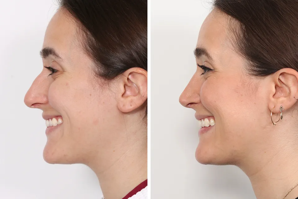 Rhinoplasty