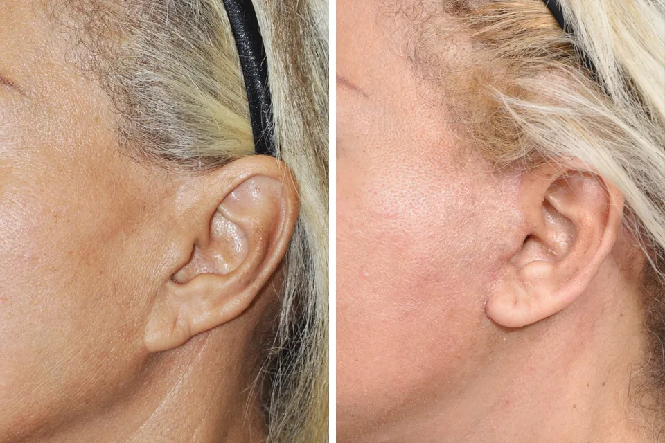 Earlobe Repair & Otoplasty