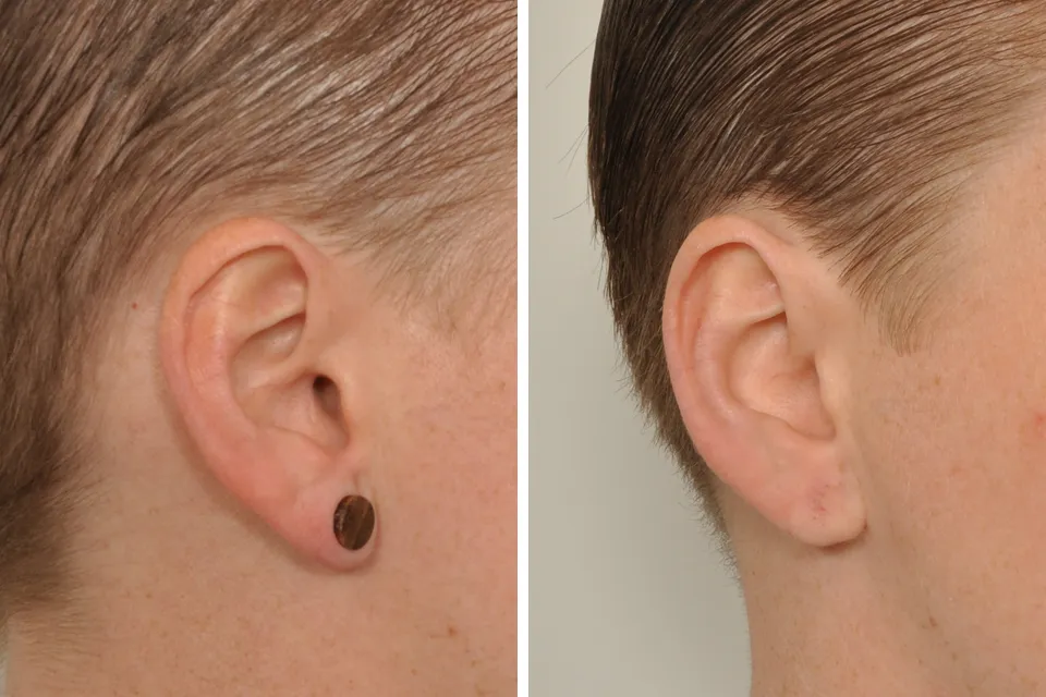 Earlobe Repair & Otoplasty