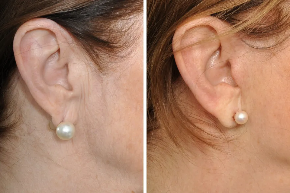 Earlobe Repair & Otoplasty