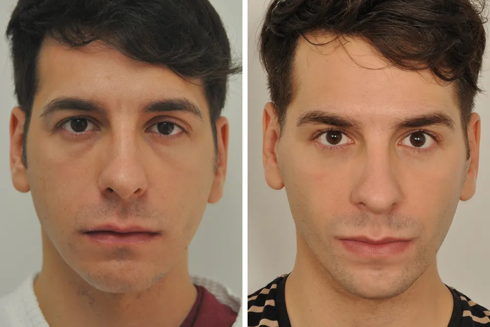 Blepharoplasty