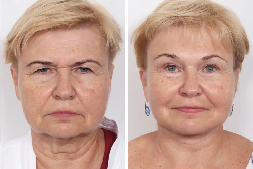 Blepharoplasty