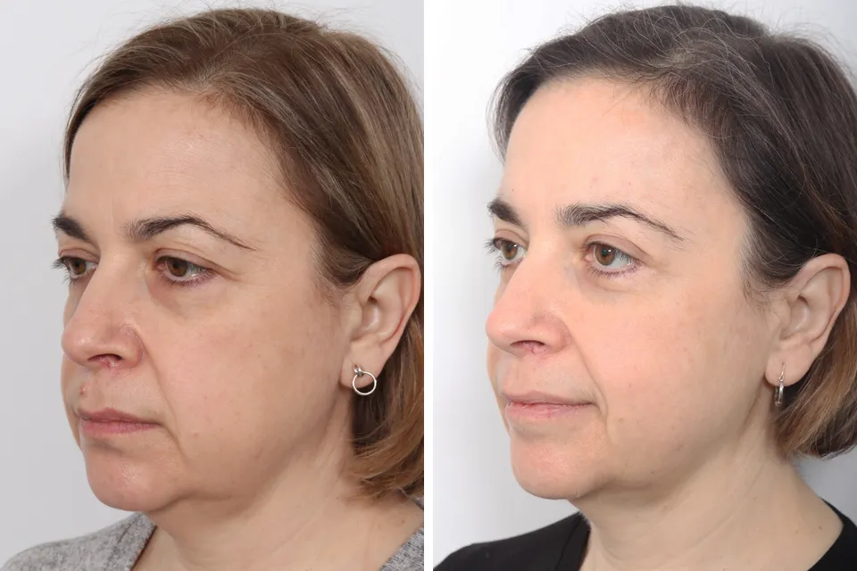 Blepharoplasty