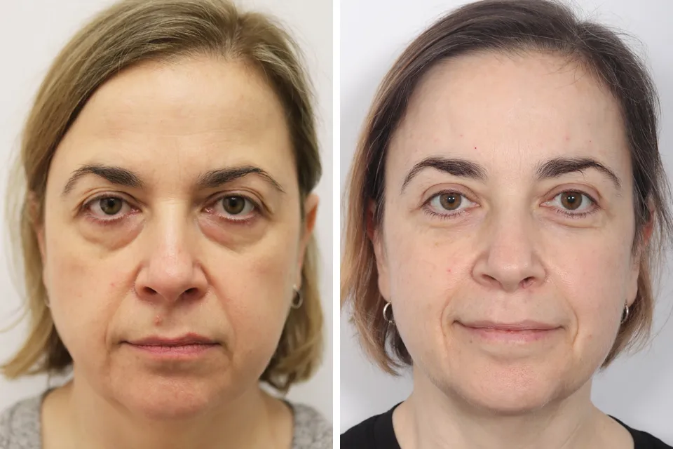 Blepharoplasty