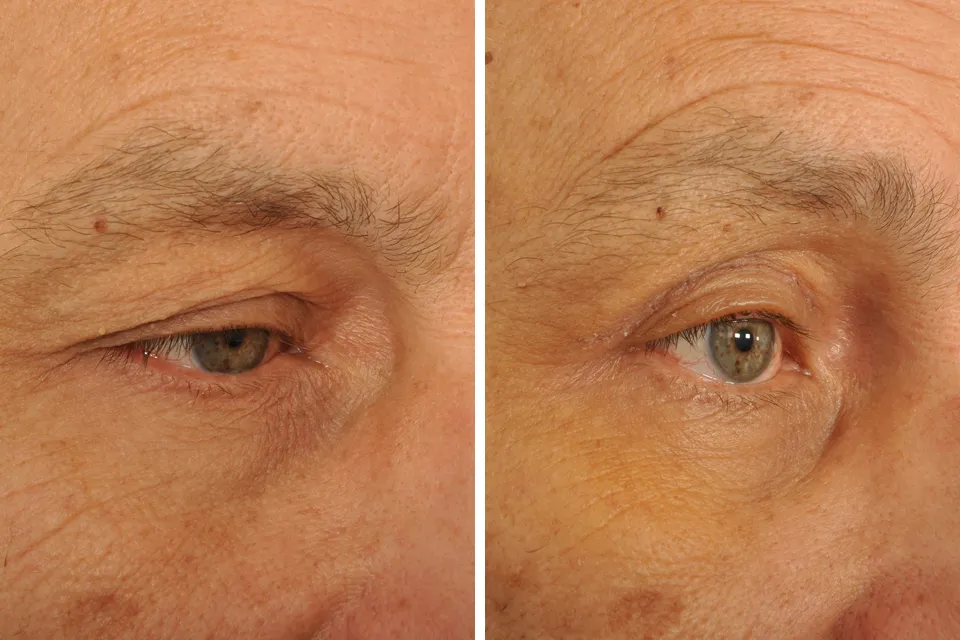 Blepharoplasty