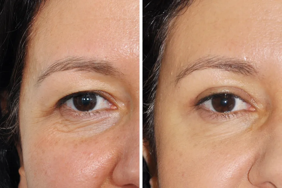 Blepharoplasty