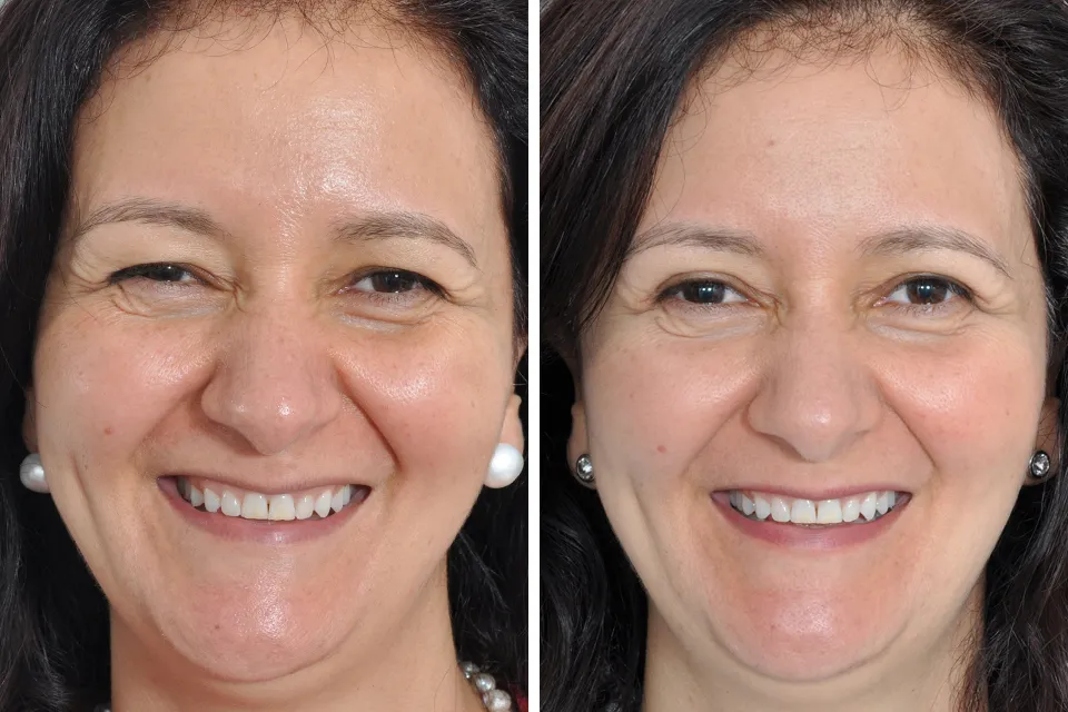 Blepharoplasty