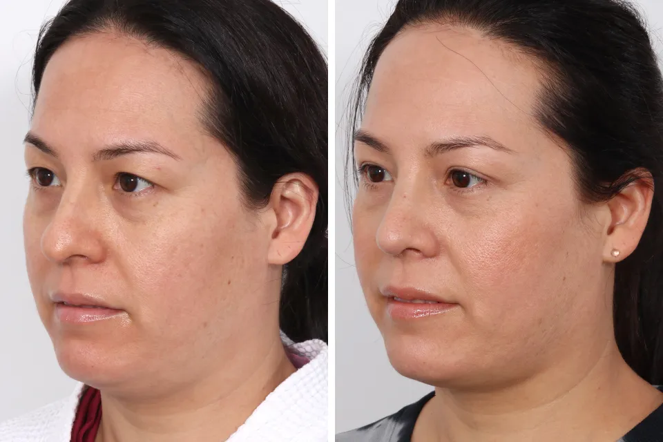 Blepharoplasty