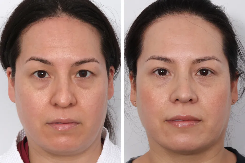 Blepharoplasty