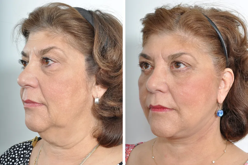 Blepharoplasty