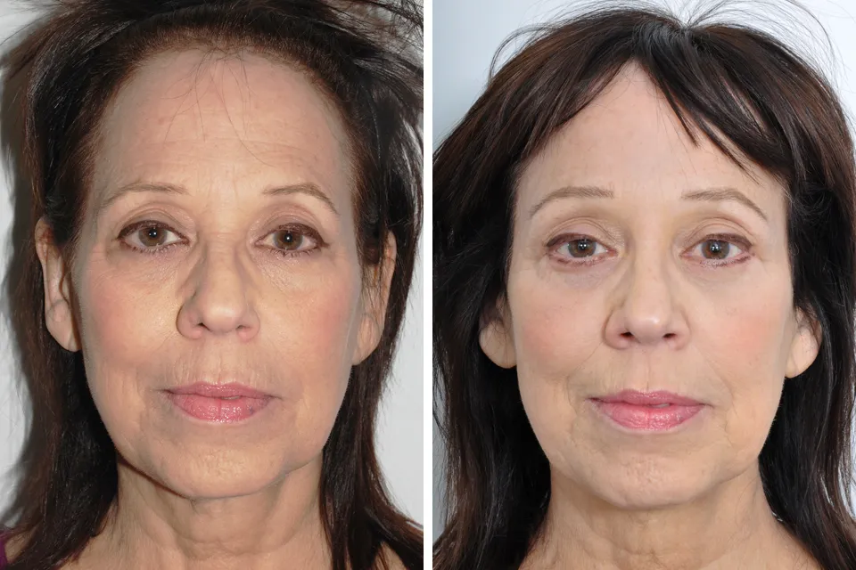 Real female patient before and after photo of Browlift and Lower Lid Blephoraplasty