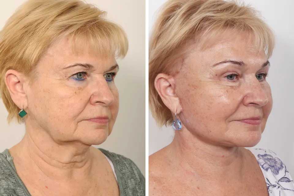 Endoscopic Brow Lift