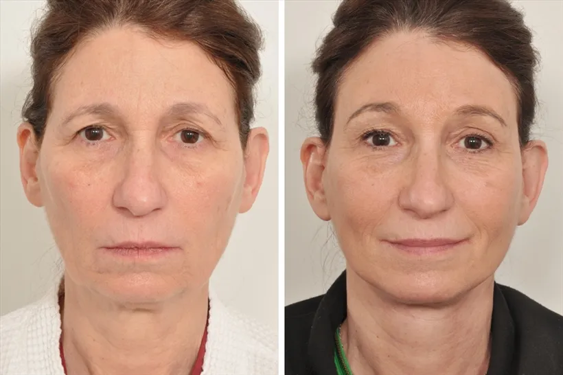 Endoscopic Brow Lift