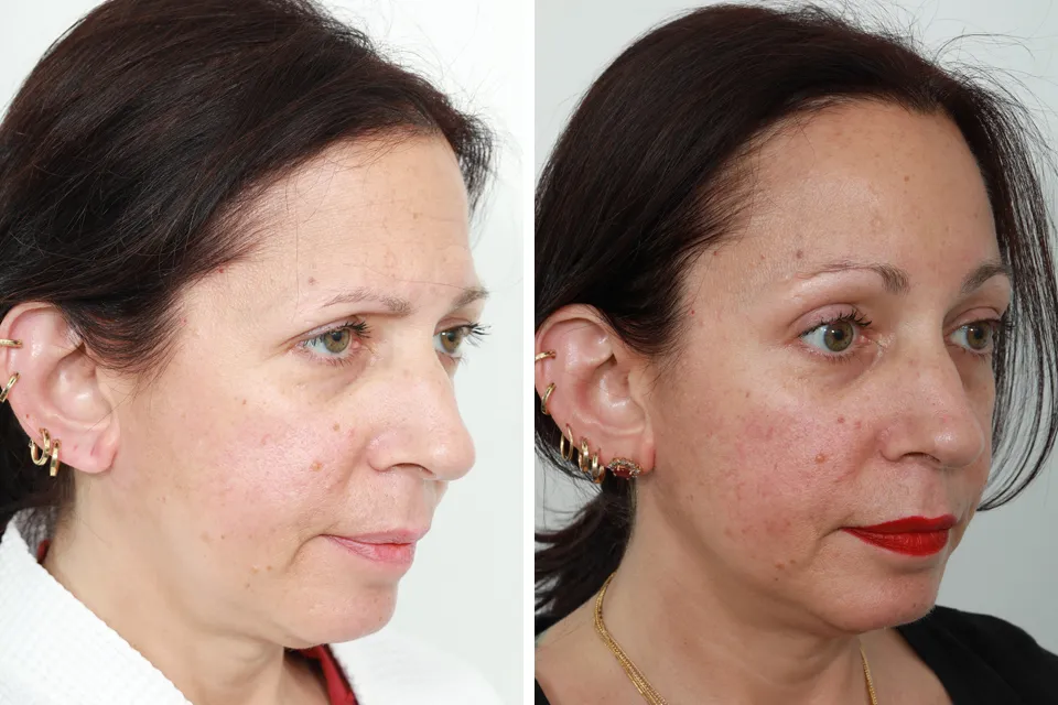 Endoscopic Brow Lift