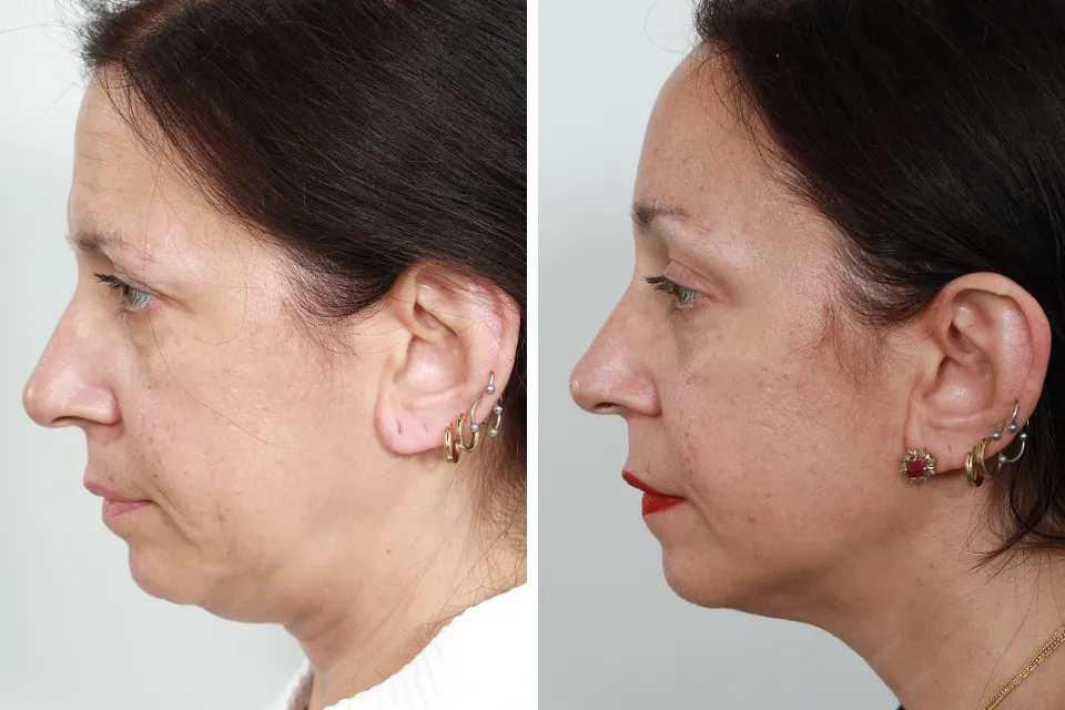 Endoscopic Brow Lift