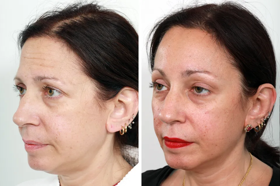 Endoscopic Brow Lift
