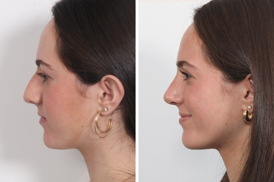 Rhinoplasty