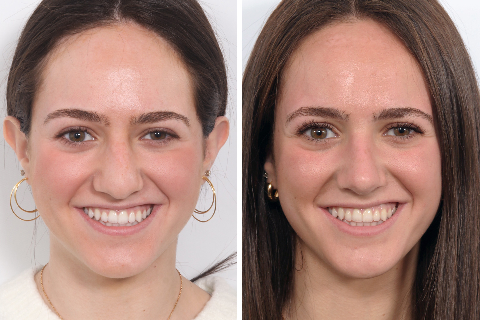 Rhinoplasty