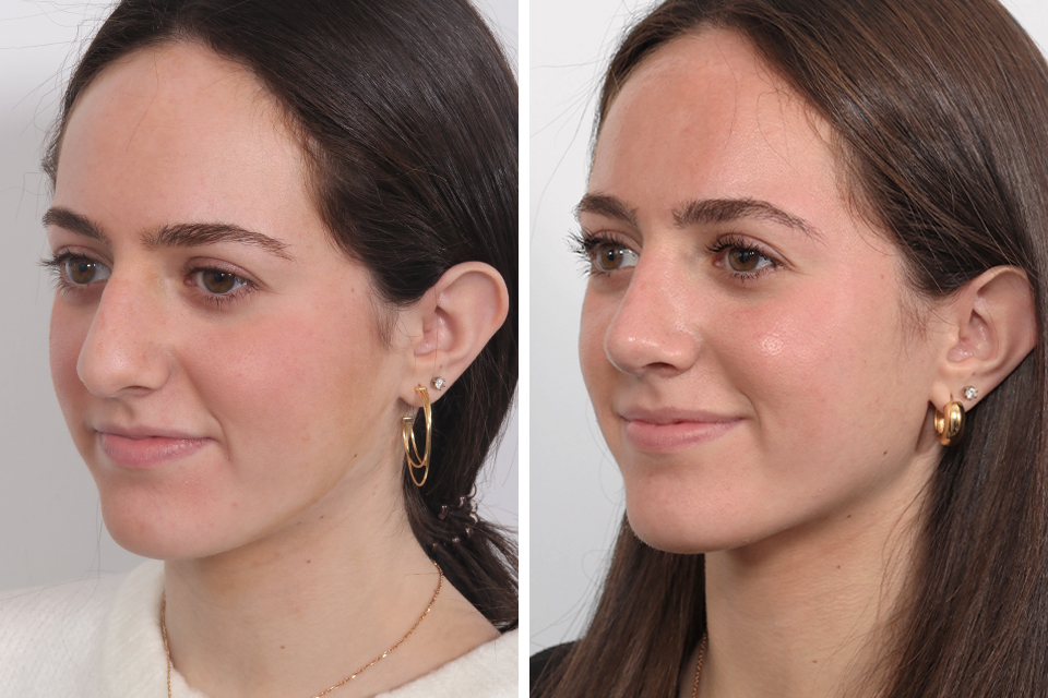 Rhinoplasty