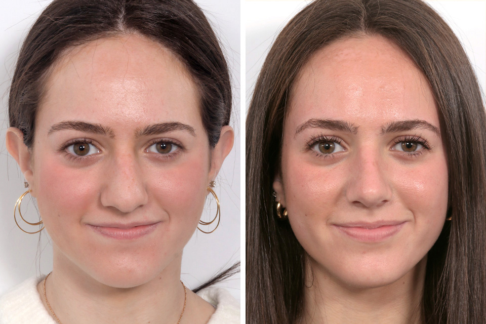 Rhinoplasty