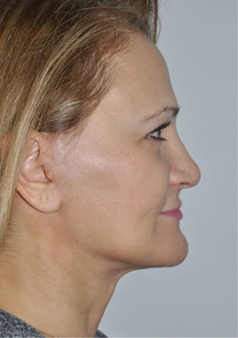 Real female facelift patient in profile 1 week post-surgery