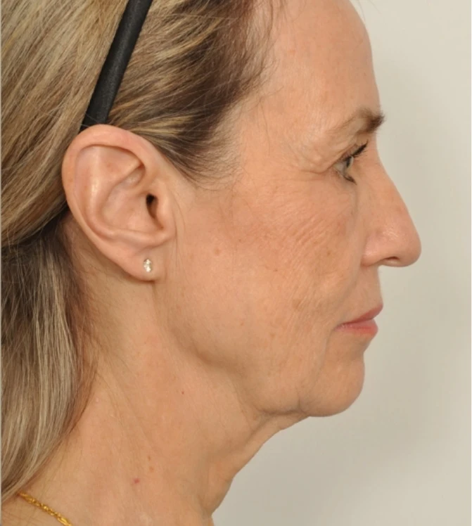Side view of an actual patient before the procedure