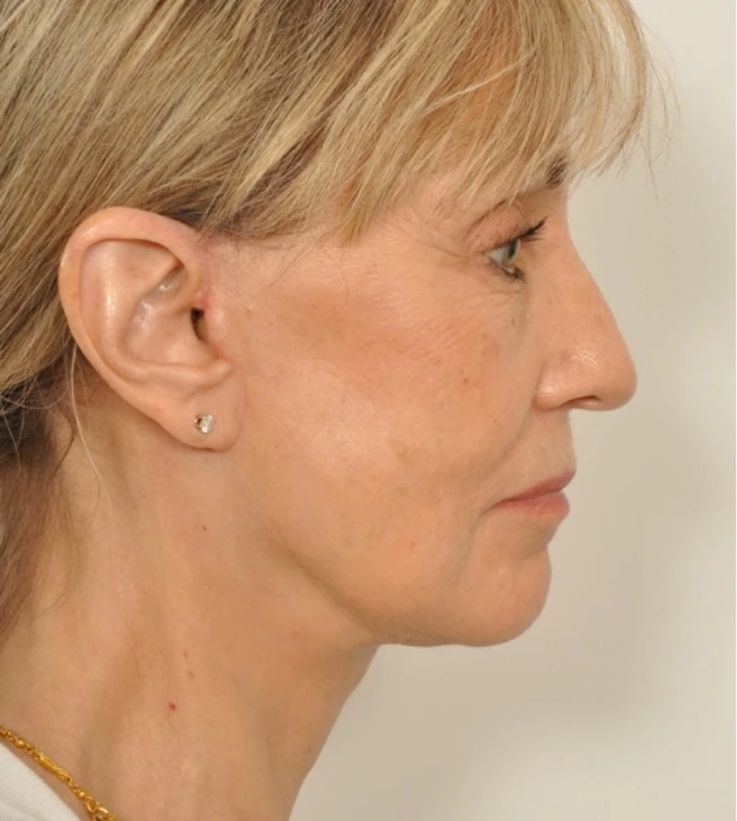 Side view of an actual patient after the procedure