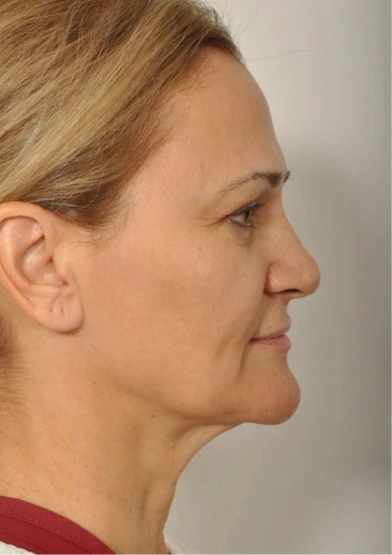 Real female patient in profile before facelift procedure