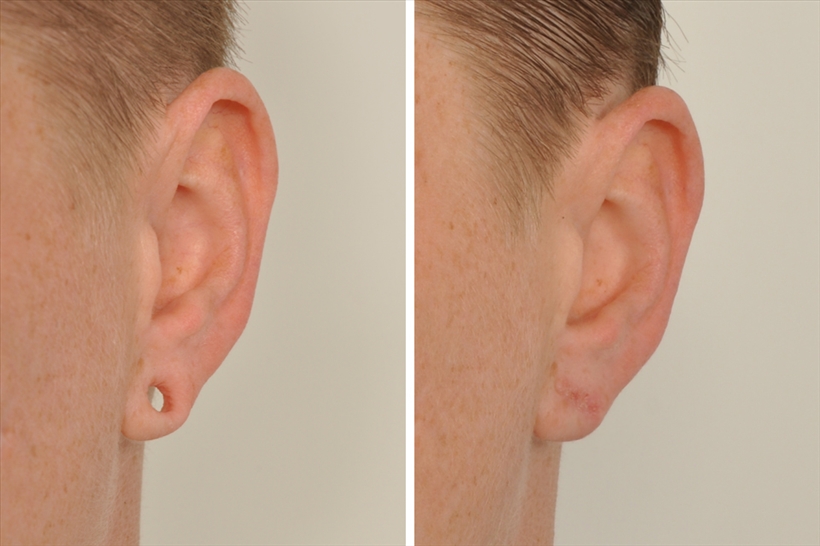 Real patient before and after photo showing earlobe repair