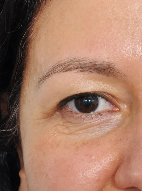 Photo close-up of actual Blepharoplasty patient before procedure
