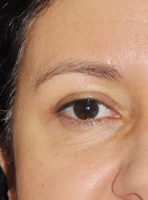 Photo close-up of actual Blepharoplasty patient after procedure