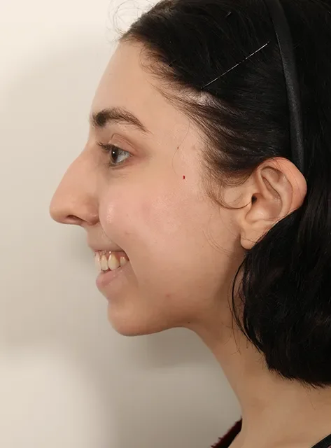 Profile of actual Chin Implant patient before procedure