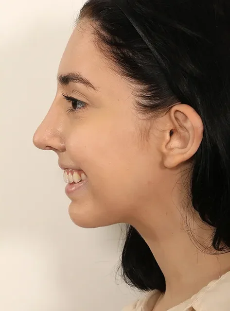 Profile of actual Chin Implant patient after procedure