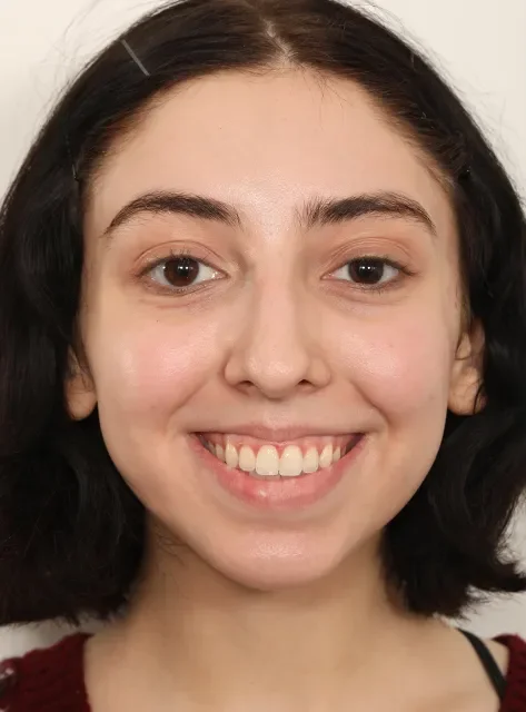 Front view of actual Chin Implant patient before procedure