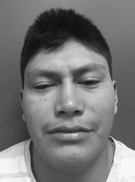 Photo of actual Facial Trauma patient after procedure