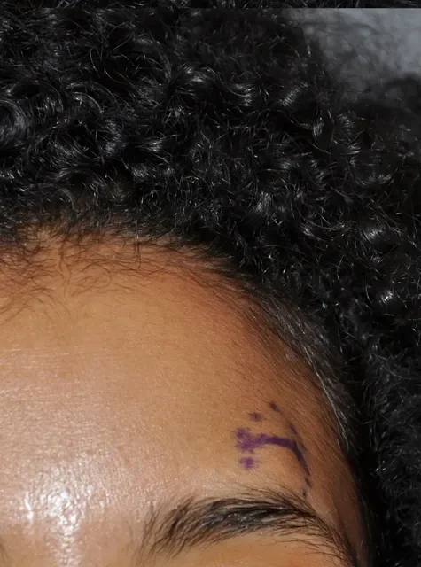 Photo of actual Forehead Osteoma patient before procedure