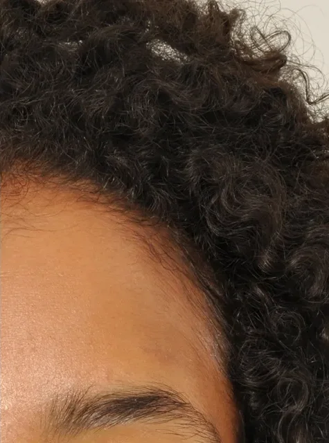 Photo of actual Forehead Osteoma patient after procedure