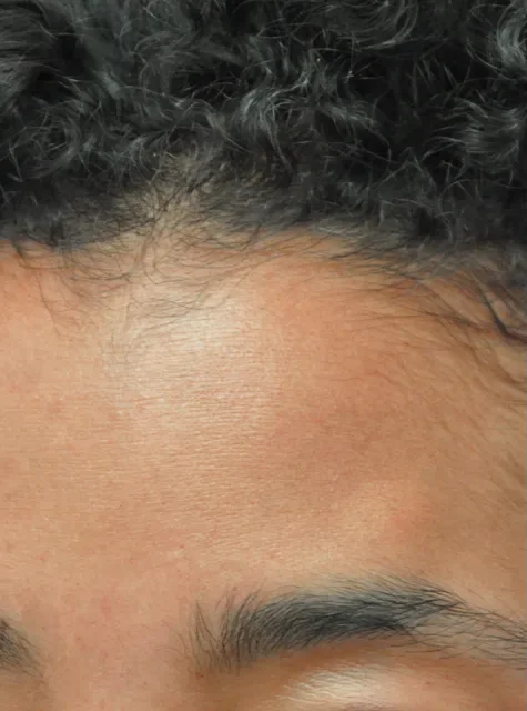 Photo of actual Forehead Osteoma patient before procedure
