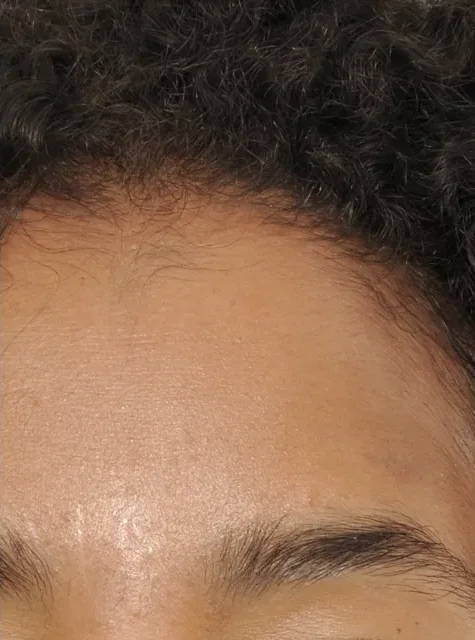 Photo of actual Forehead Osteoma patient after procedure